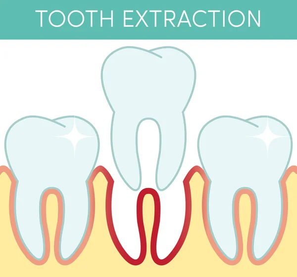 Удаление зубов — стоковый вектор