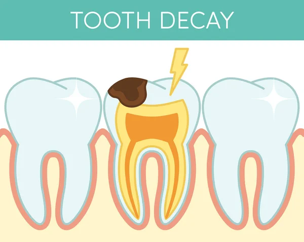 Caries dental que afecta — Archivo Imágenes Vectoriales