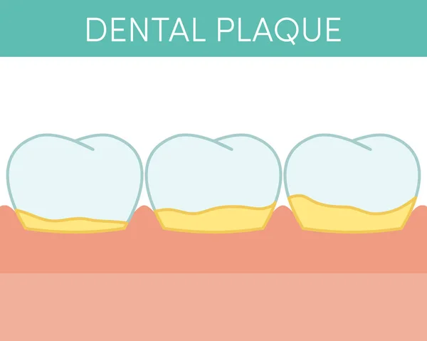 Dental plak kavramı — Stok Vektör