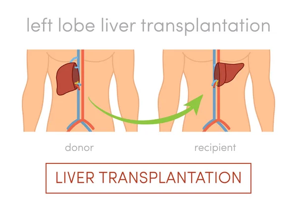 Concept de transplantation hépatique — Image vectorielle