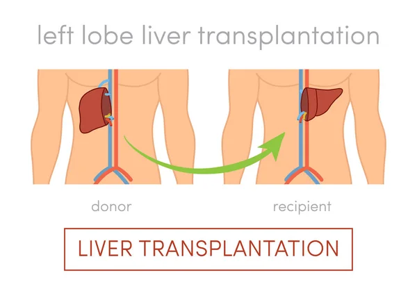 Concepto de trasplante de hígado — Vector de stock