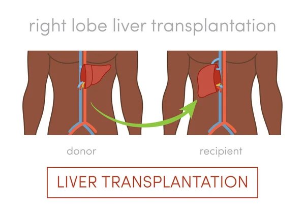 Levertransplantation koncept — Stock vektor