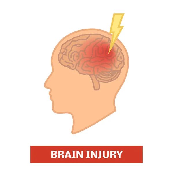 Концепція травми головного мозку Ліцензійні Стокові Ілюстрації