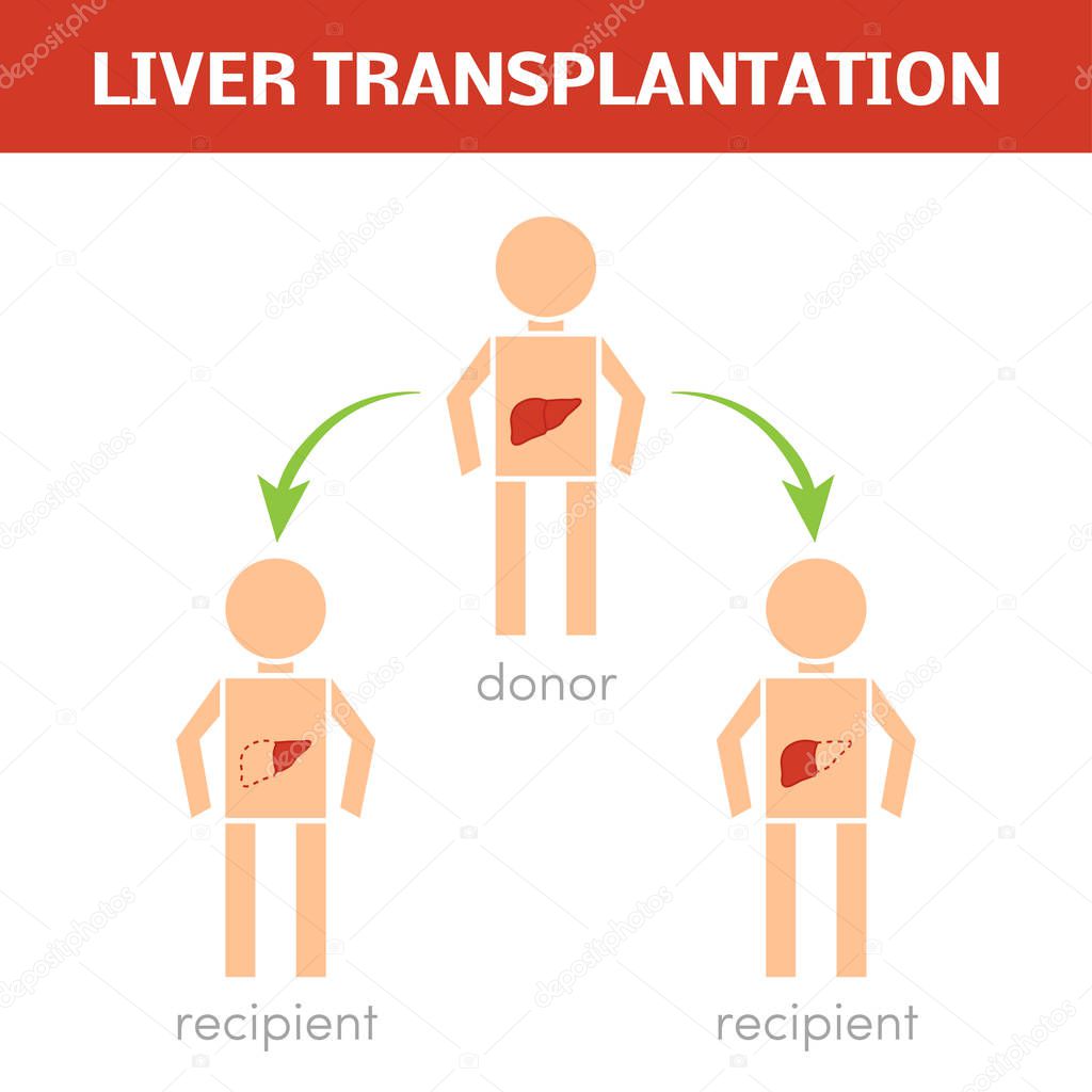Liver transplantation concept