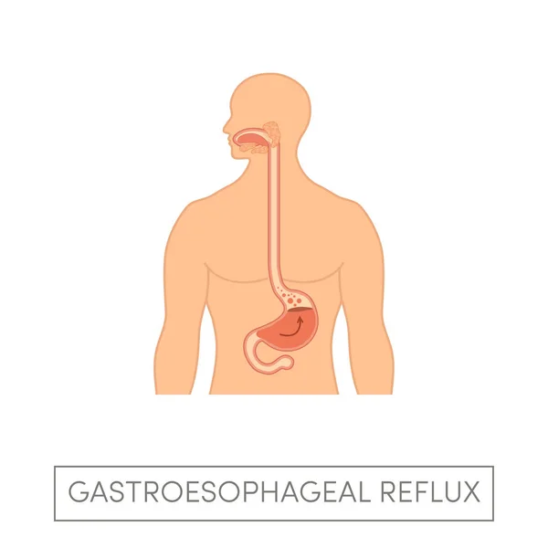 Gastroesophageal reflux disease — Stock Vector