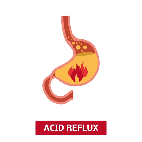 Ícones de vetor de refluxo ácido — Vetor de Stock