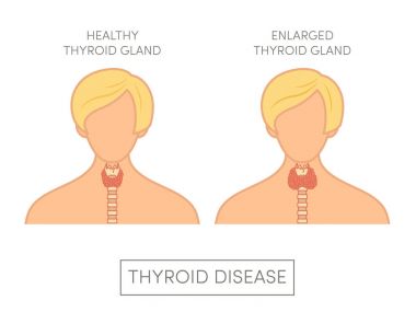 Erkek büyümüş tiroid bezi ile