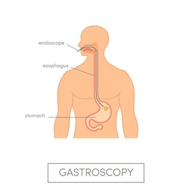 Medicine  gastroscopy concept clipart