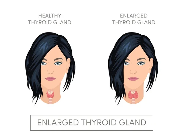 Agrandamiento de la glándula tiroides — Vector de stock