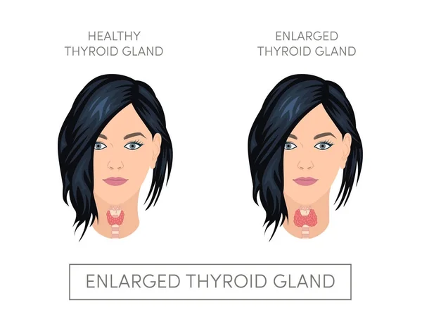 Enlarged thyroid gland — Stock Vector