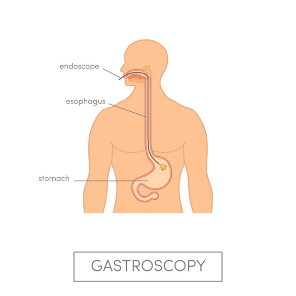 Medicina concepto de gastroscopia — Archivo Imágenes Vectoriales