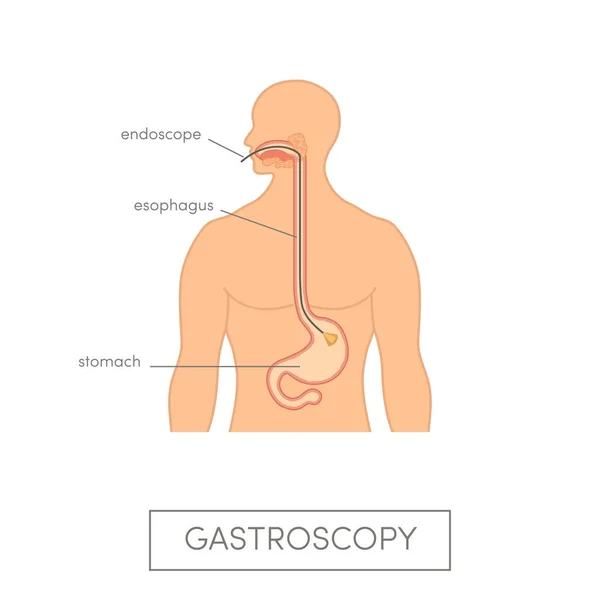 Medizin Gastroskopie Konzept — Stockvektor