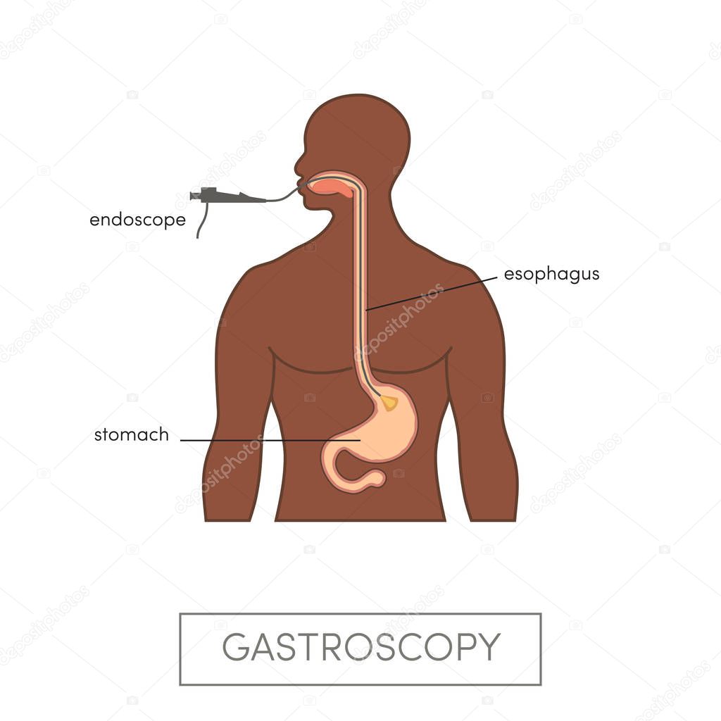 Medicine gastroscopy concept — Stock Vector © marina_ua 170672056