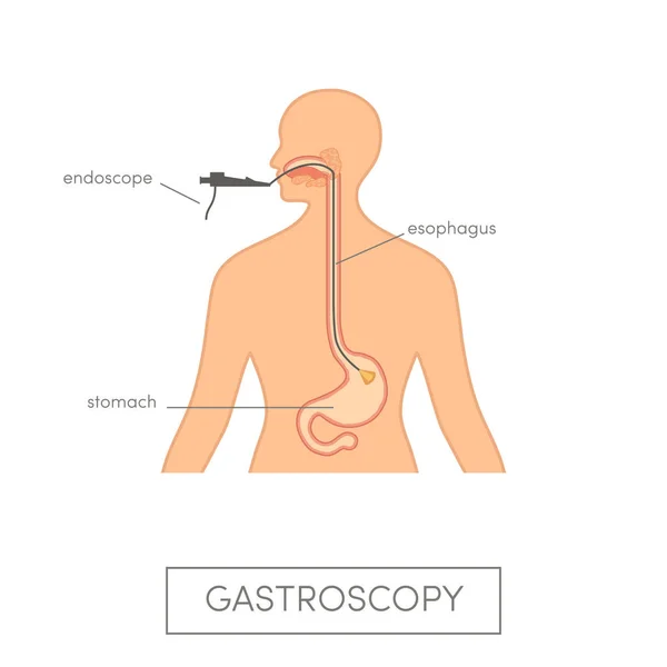 Concepto Gastroscopia Vectorial Mujer Caucásica Recibiendo Examen Endoscópico — Vector de stock