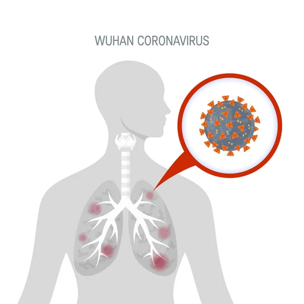 Coronavirus Konzept Wuhan 2019 Ncov Menschen Mit Kranken Lungen Vektor — Stockvektor