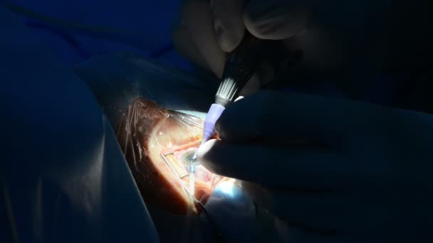 Clinique ophtalmique, chirurgie — Video