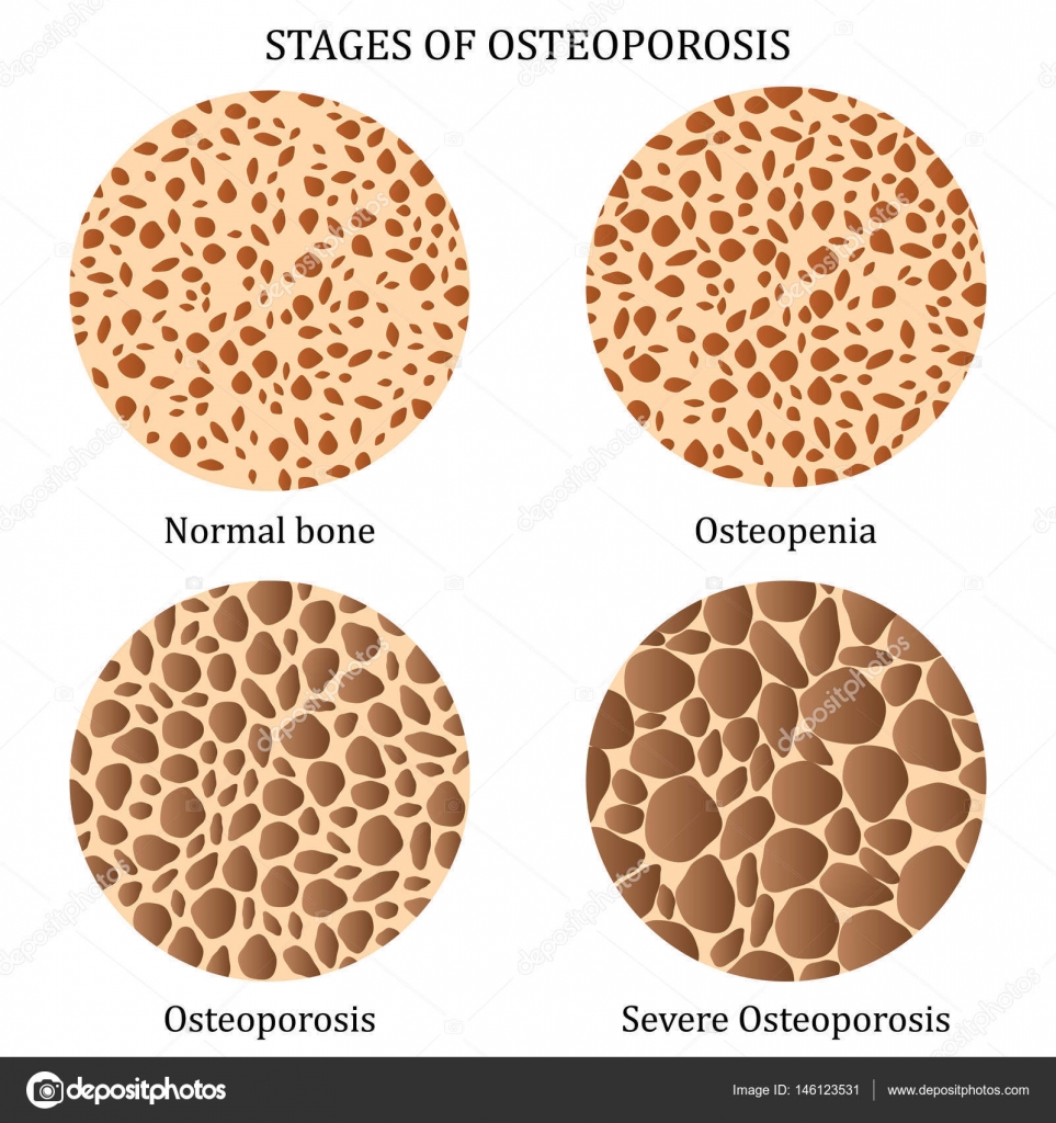 Stages of osteoporosis. Stock Vector Image by ©Neokryuger #146123531 Stages of osteoporosis. Stock Vector Image by ©Neokryuger #146123531