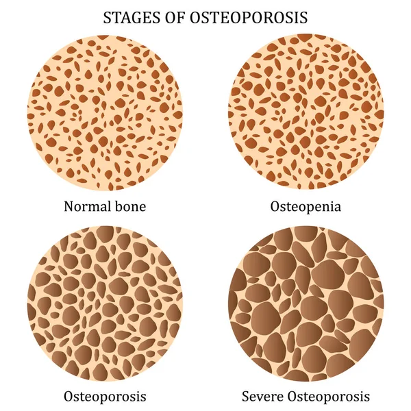 Tahapan Osteoporosis . - Stok Vektor