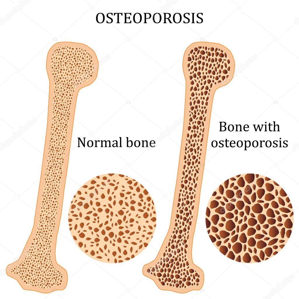 Healthy Bone And Osteoporosis Bone Stock Vector Neokryuger 147891355 healthy-bone-and-osteoporosis-bone-stock-vector-neokryuger-147891355