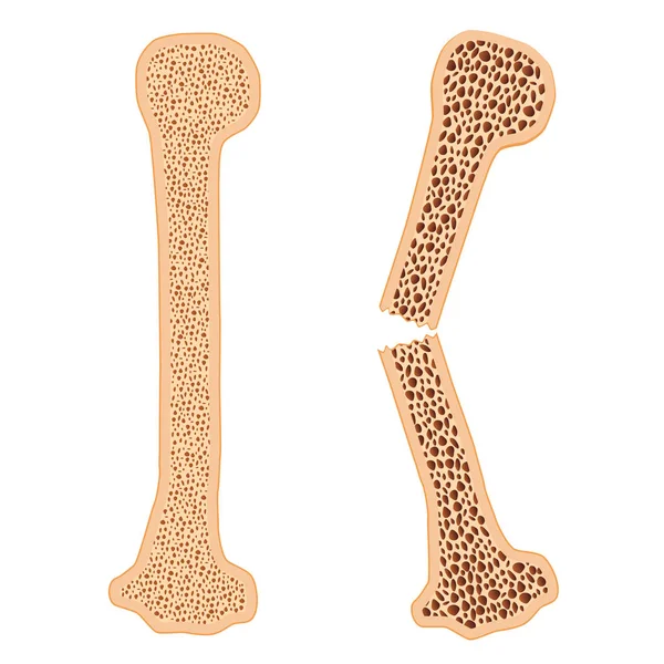 Hueso sano y hueso roto con osteoporosis . — Vector de stock