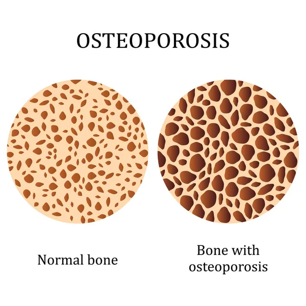 Osso e osso saudáveis com osteoporose . — Vetor de Stock