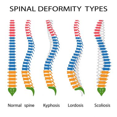 Spinal deformity types. clipart