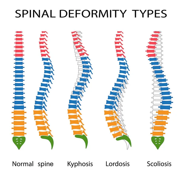 Spinal deformite türleri. Telifsiz Stok Vektörler