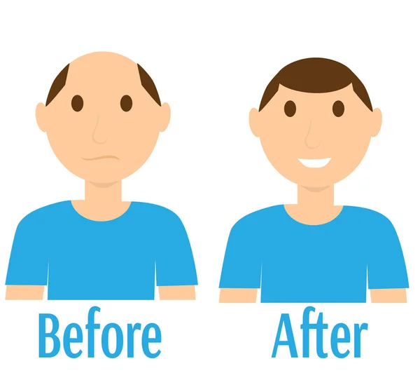 Antes y después del trasplante de cabello — Archivo Imágenes Vectoriales