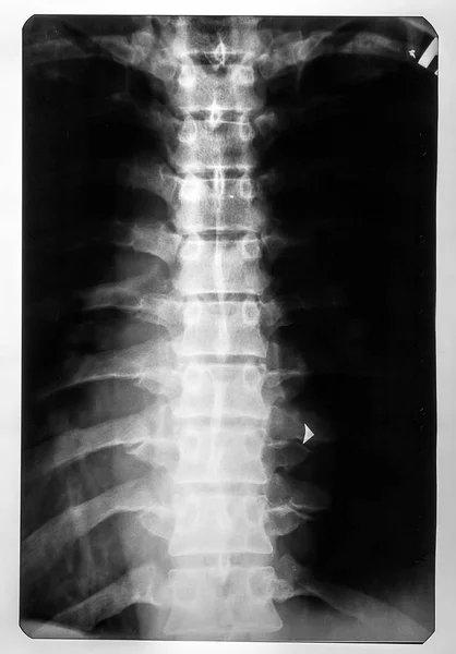 X-ray of the spinal card — Stock Photo, Image