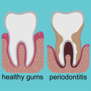 Periodontitli diş eti ile diş eti arasındaki fark