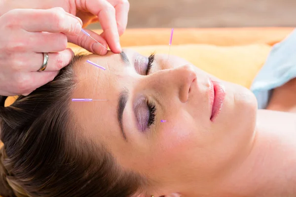 Ajuste del terapeuta agujas de acupuntura — Foto de Stock