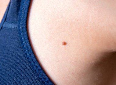 Kadın vücudunda köstebek closeup