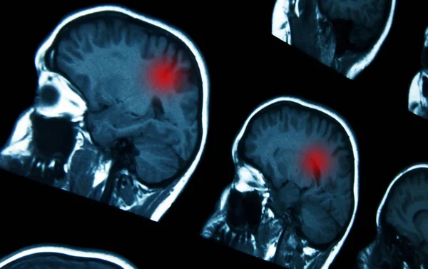 МРТ мозга с проблемами — стоковое фото