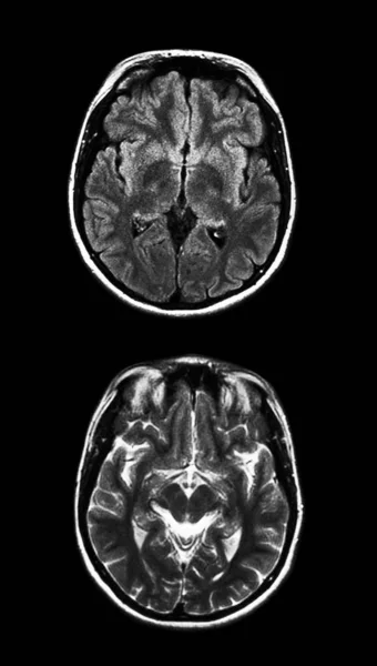 Ressonância magnética cerebral no preto — Fotografia de Stock