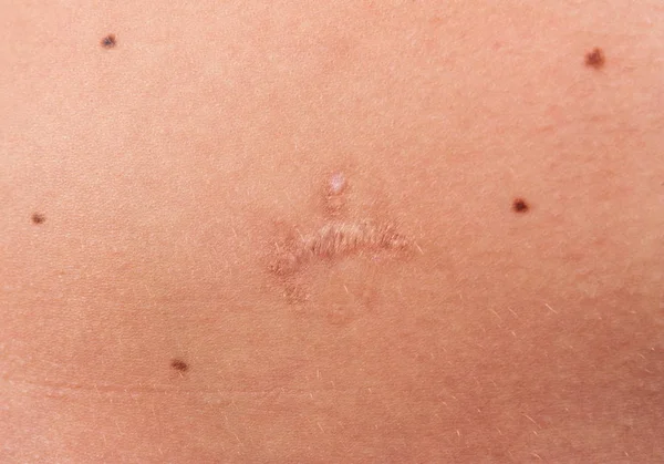Ουλή μετά την αφαίρεση mole — Φωτογραφία Αρχείου