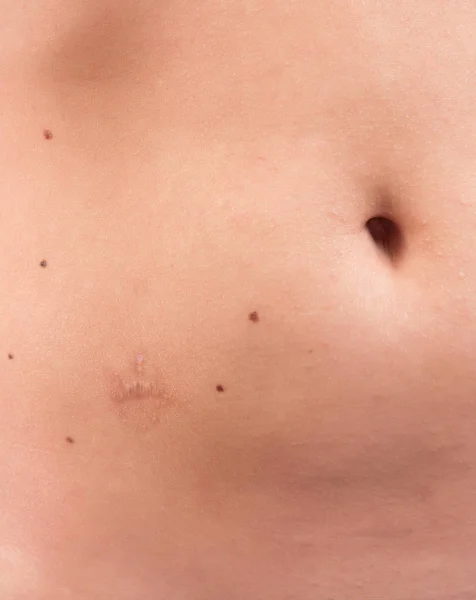 Scar after the mole removal — Stock Photo, Image