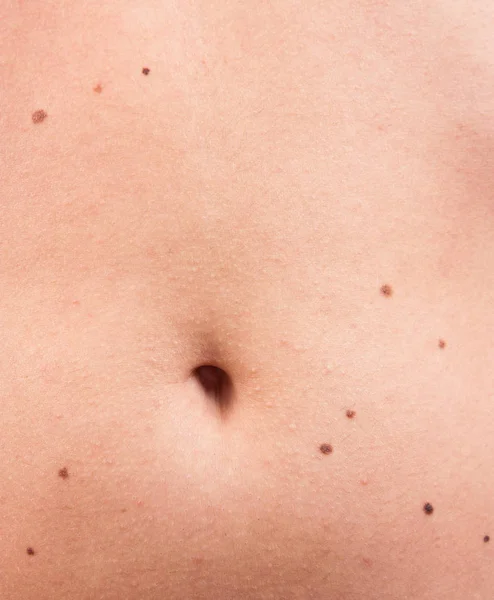 Many moles on the female belly — Stock Photo, Image