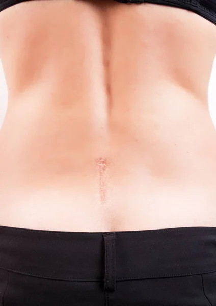 Scar on the female back after the spine surgery — Stock Photo, Image