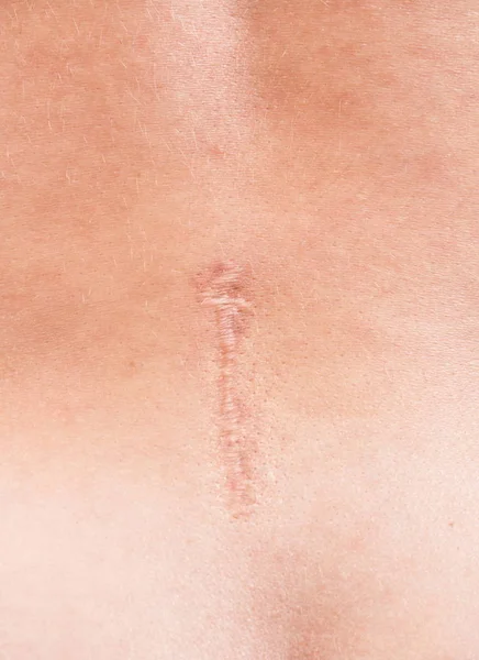 Cicatrice sulla schiena femminile dopo l'intervento alla colonna vertebrale — Foto Stock