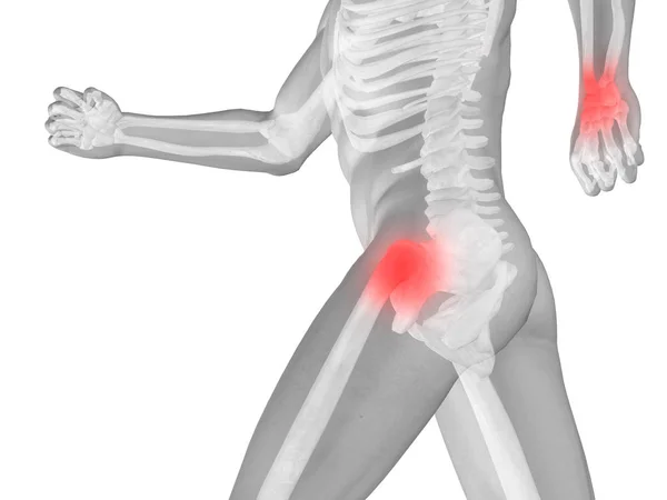 Человеческие мышцы с болью в суставах или костях — стоковое фото