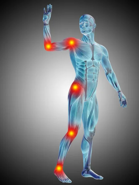 Anatomía del cuerpo humano con signos de inflamación — Foto de Stock