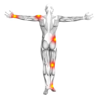 Conceptual human muscle anatomy with red and yellow hot spot inflammation or articular joint pain for health care therapy or sport concepts. 3D illustration man arthritis or bone osteoporosis disease clipart