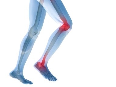 eklemlerin eklem ağrısı