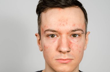 Alerjisi olan, kırmızı yüzlü bir gencin portresi. Yakın çekim..