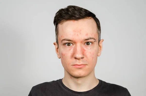 Retrato de un joven con alergia, con la cara roja. Primer plano. . — Foto de Stock