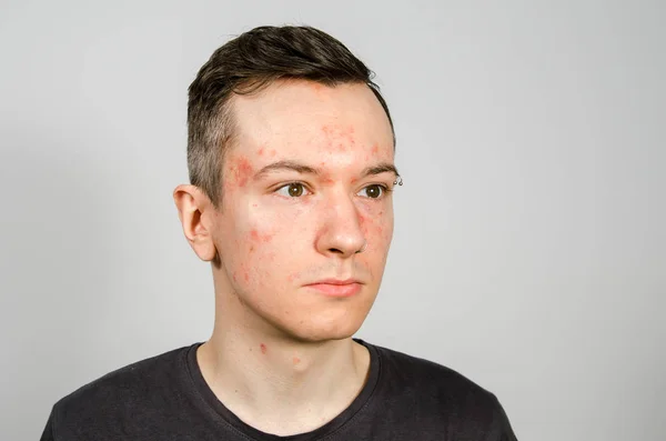 Retrato de um jovem com alergia, com cara vermelha. Fechar. . — Fotografia de Stock