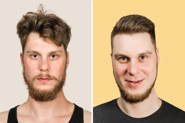 Cara careca antes depois de corte de cabelo Conceito para uma barbearia: o homem problema de perda de cabelo, alopecia, transplante — Fotografia de Stock