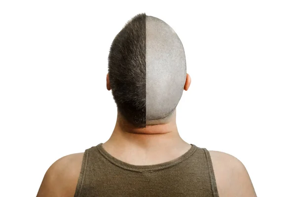 Man före och efter håravfall, transplantera på en isolerad bakgrund. bakåtsikt — Stockfoto