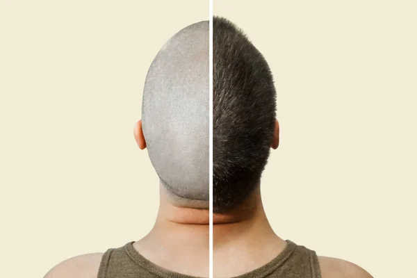 Man before and after hair loss, transplant on a isolated background. back view