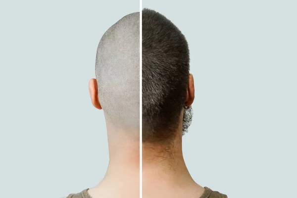 Homem antes e depois da perda de cabelo, transplante em um fundo isolado. vista para trás — Fotografia de Stock